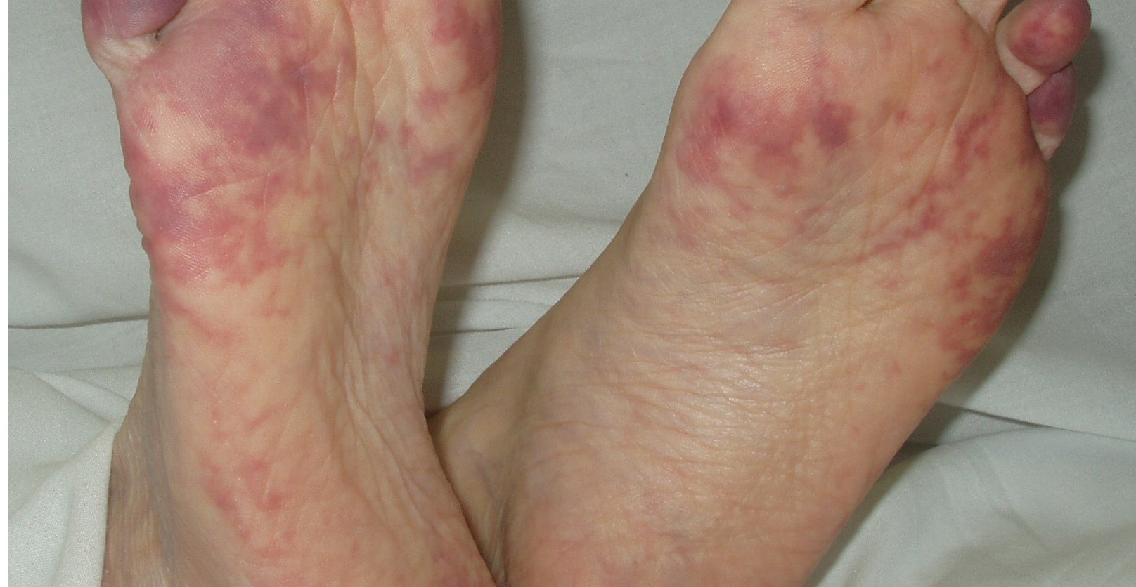 Purple Blue Toe Syndrome