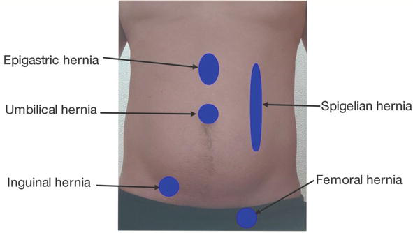 Nclex Rn Question On Assessing A Client With A Herniated Abdomen Studypk