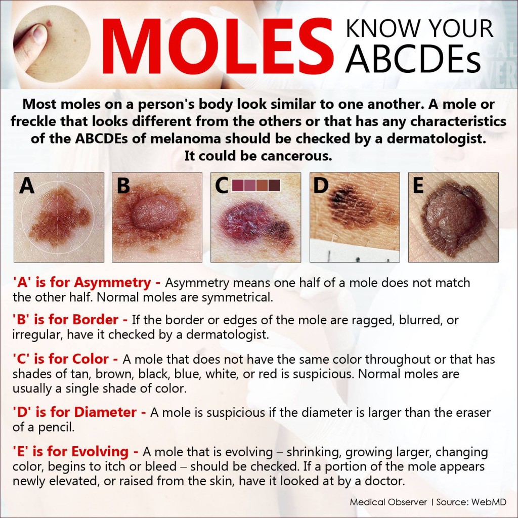 moles-know-your-abcdes-studypk