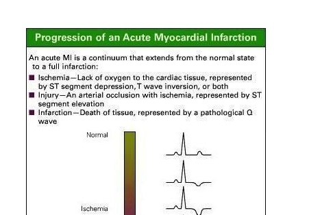 nursing case study on myocardial infarction