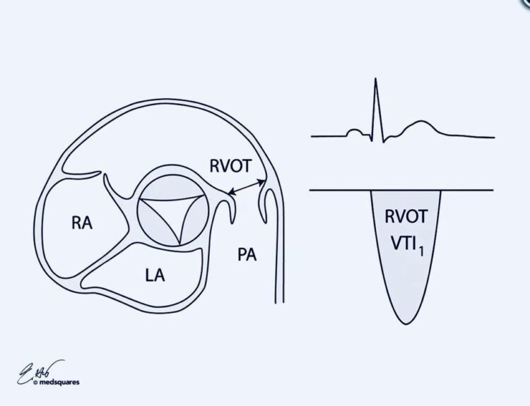 #CCU_ECHO Pulmonary-Systemic Shunt Ratio { Qp / Qs } - StudyPK