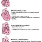Cardiomyopathy Types Mnemonics Cheat Sheets for Nursing Students