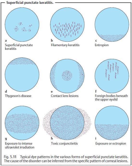 Superficial Punctate Keratitis Spk