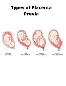 Comprehensive Guide to Placenta Location and Placenta Previa Types ...