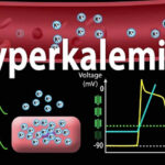 NCLEX Practice Quiz: Sodium Polystyrene Sulfonate for Hyperkalemia