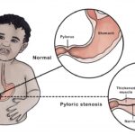 NCLEX Practice Quiz on Pyloric Stenosis: Assessment Findings